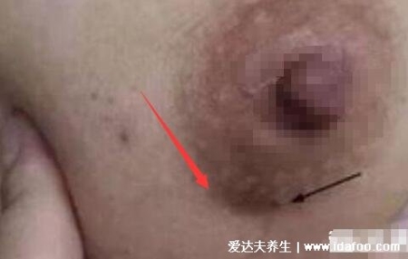 乳腺癌的15个征兆图片，警惕乳房凹陷/乳头溢液/肿块/橘皮样改变