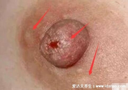 乳腺癌的15个征兆图片，警惕乳房凹陷/乳头溢液/肿块/橘皮样改变