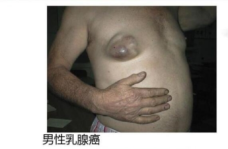 乳腺癌的15个征兆图片，警惕乳房凹陷/乳头溢液/肿块/橘皮样改变