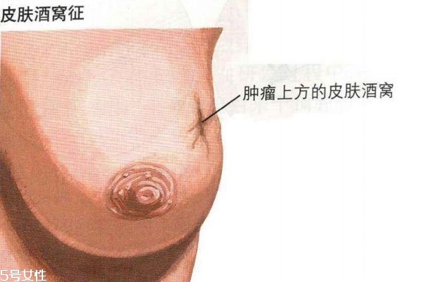 乳腺癌的早期症状 带你认识乳腺癌