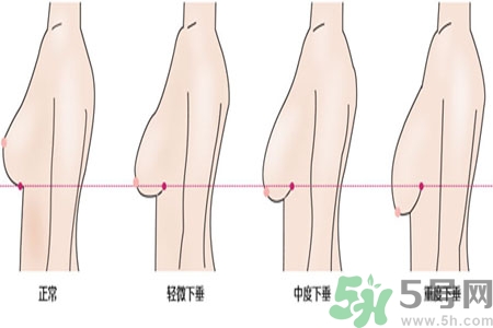 ​女性乳房下垂的原因是什么？女性乳房下垂的分类有哪些？