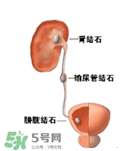 肾结石有什么症状？肾结石原因