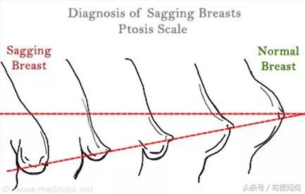 哺乳妈妈胸部扁平下垂原因（乳房下垂是因为喂奶）(2)