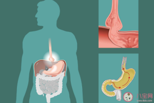 怎么判断有没有胃食管反流 胃食管反流哪些是危险人群