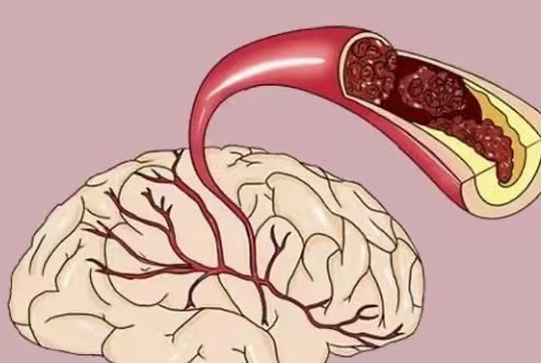 睡觉时出现哪些症状可能是脑血管堵了