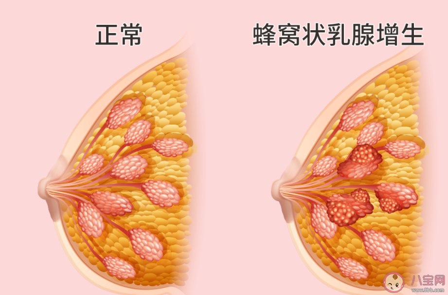 乳腺增生真是被气出来的吗 爱生气对女生伤害有多大