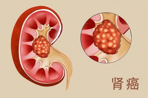 肾癌一检查就是晚期3个早期症状要留意