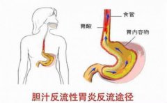 胆汁反流性胃炎有什么症状该如何治疗