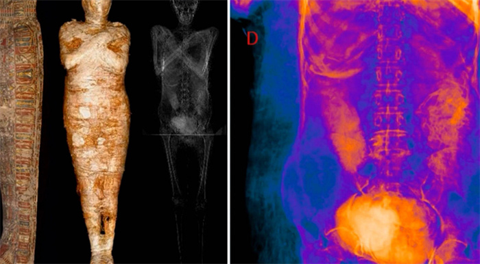 专家发现一具木乃伊 腹中居然还有胎儿（怀孕木乃伊）