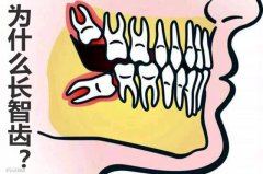 人为什么会长智齿_智齿一定要拔吗？